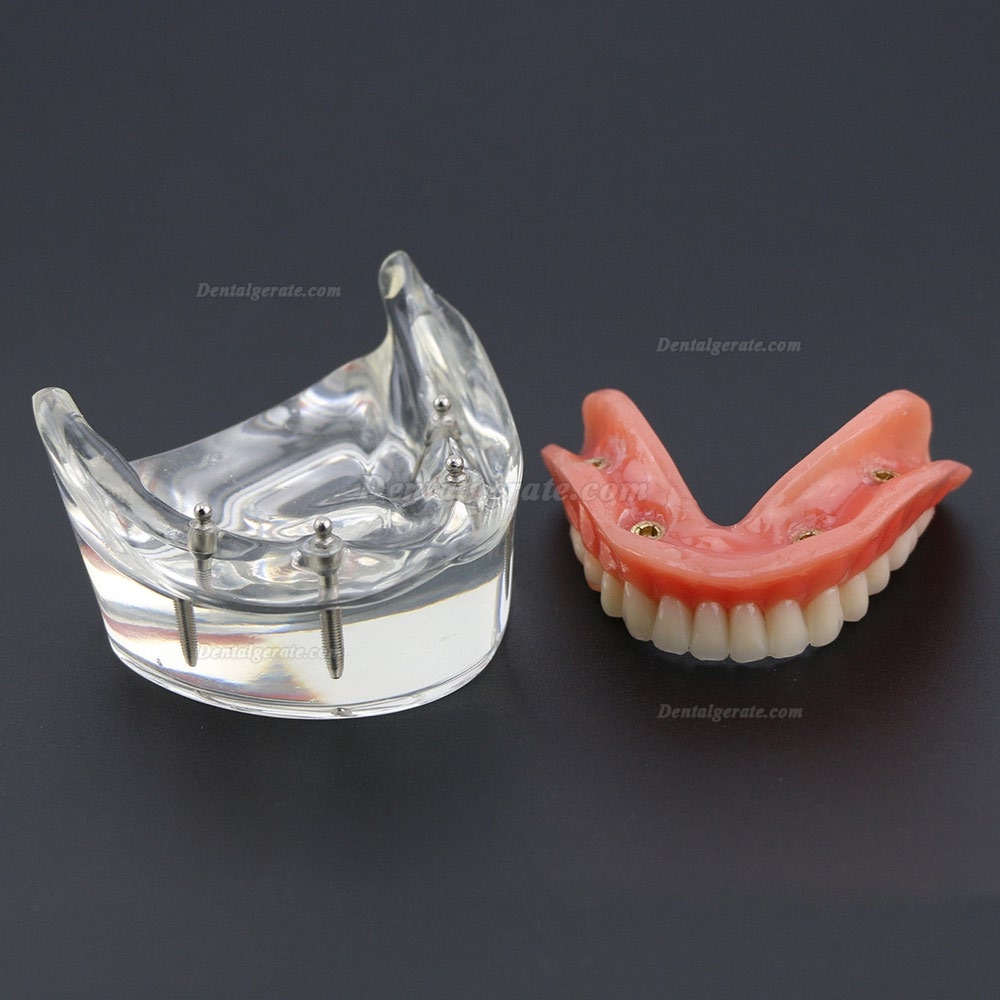 Dental Lower Z&auml;hne Demo-Studienmodell 6002 02 Overdenture Unten 4 Implantate